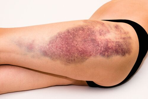 How to reduce bruising after vein surgery? How to reduce bruising after vein surgery?