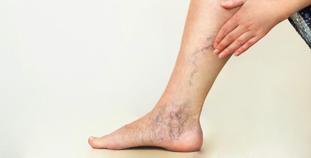 8 Warning Signs of Vein Disease: #4 Swollen Ankles 1 After