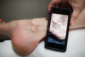 the best way to treat spider veins