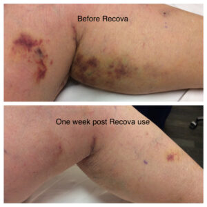 one way to reduce bruising after surgery 