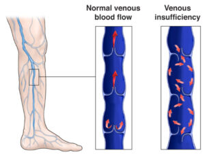 venous reflux disease