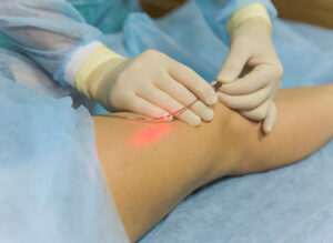 evla treatment