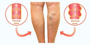 leakyveinvalves