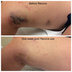one way to reduce bruising after surgery