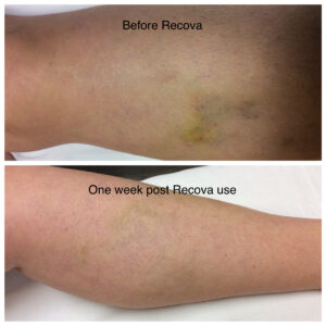 one way to reduce bruising after surgery