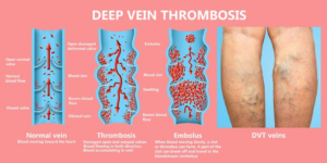 deep vein thrombosis