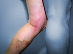 deep vein clots