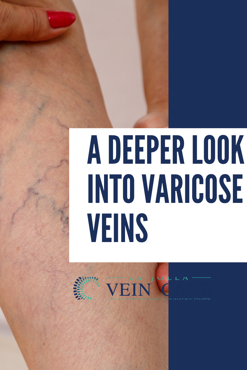 varicose veins