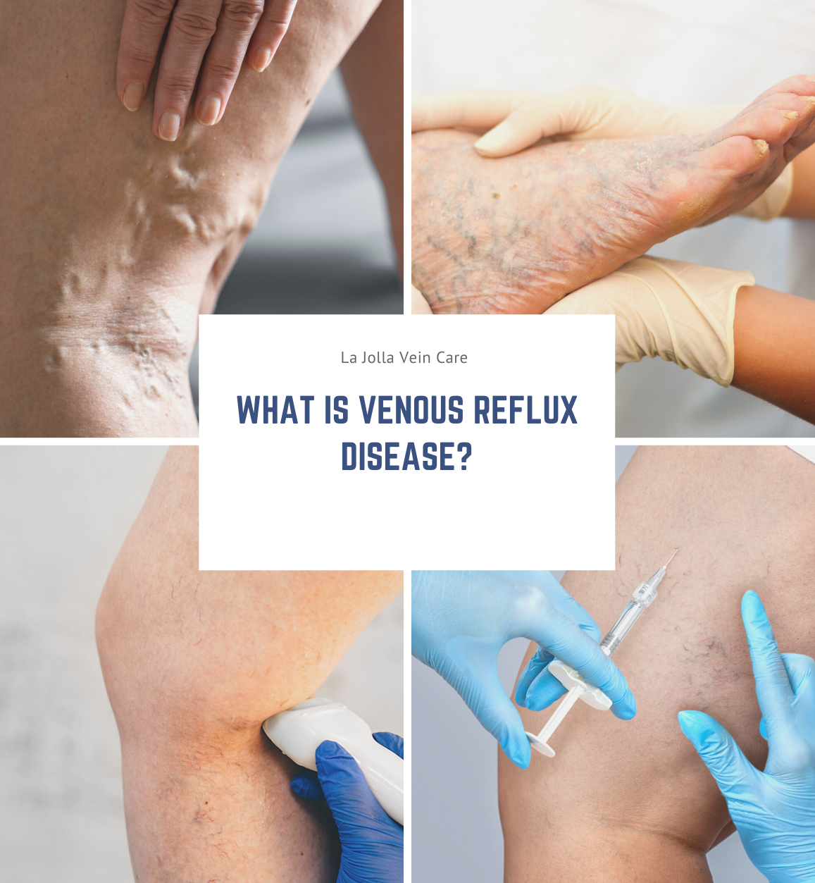 venousrefluxdisease