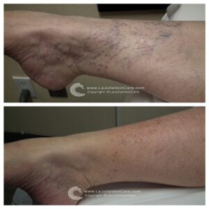 spider veins