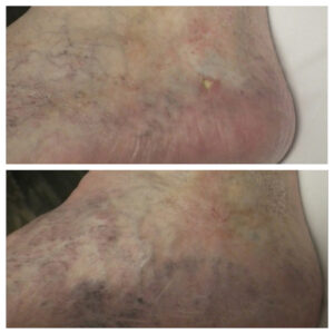 leg ulcers