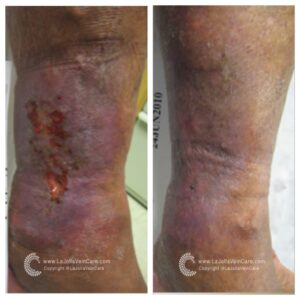 5 BA VLU ulcer foam results 6 fotor