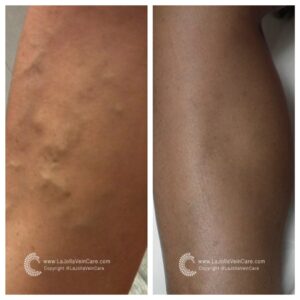 varicose veins