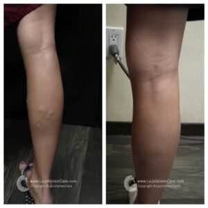 varicose veins
