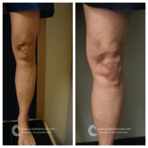 varicose veins