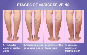 varicose