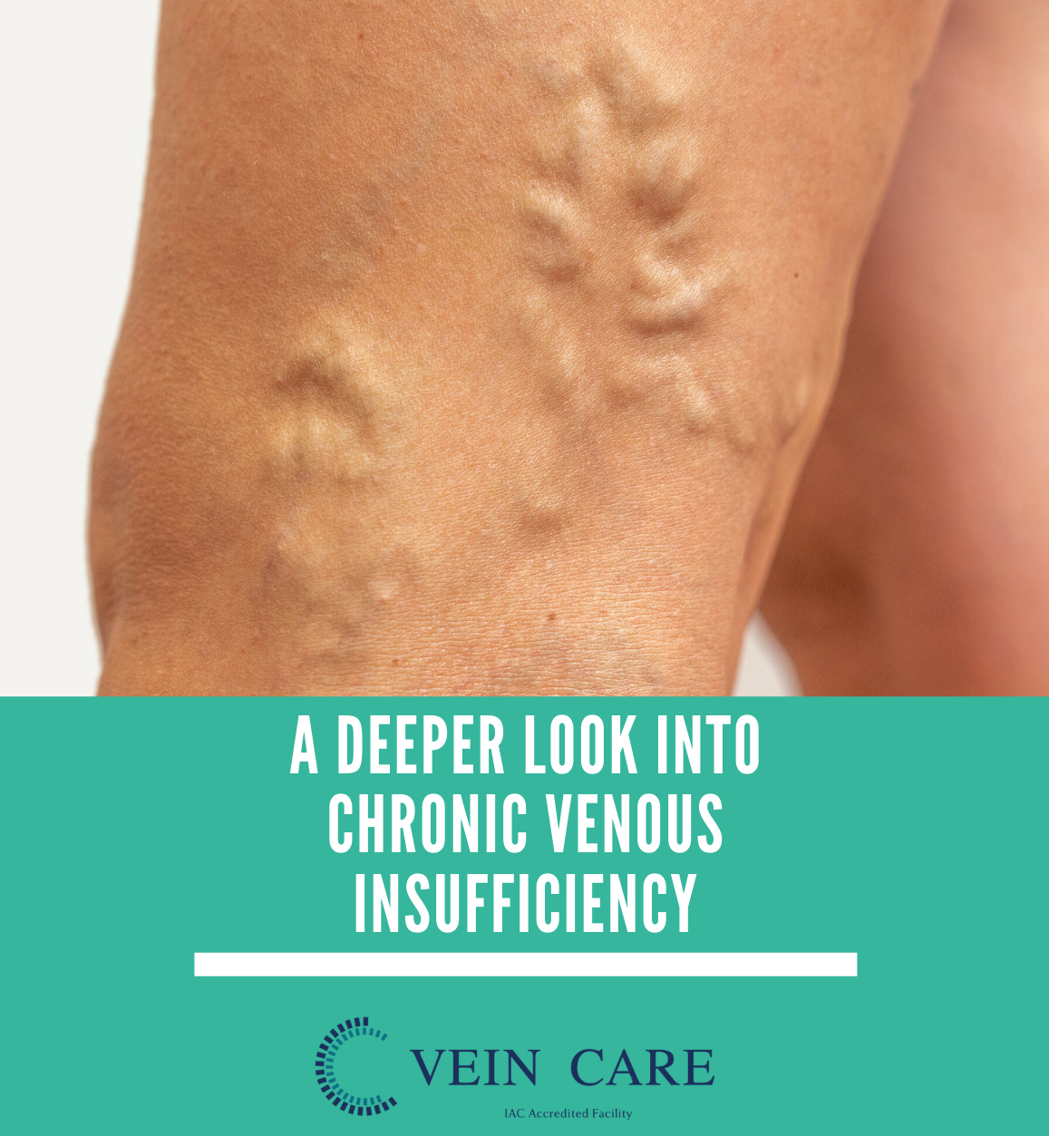chronic venous