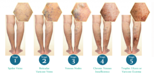venous stage