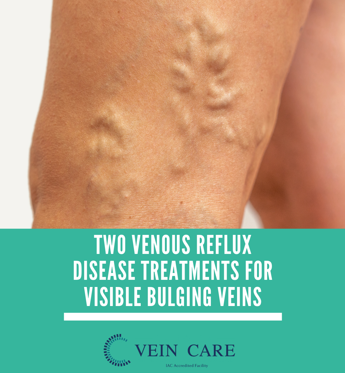 bulging veins