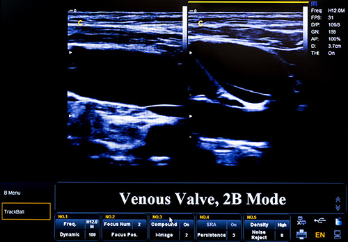 duplexultrasound
