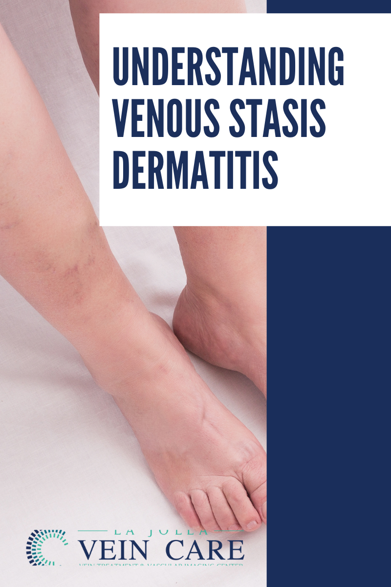 understanding venous stasis Venous Stasis Dermatitis