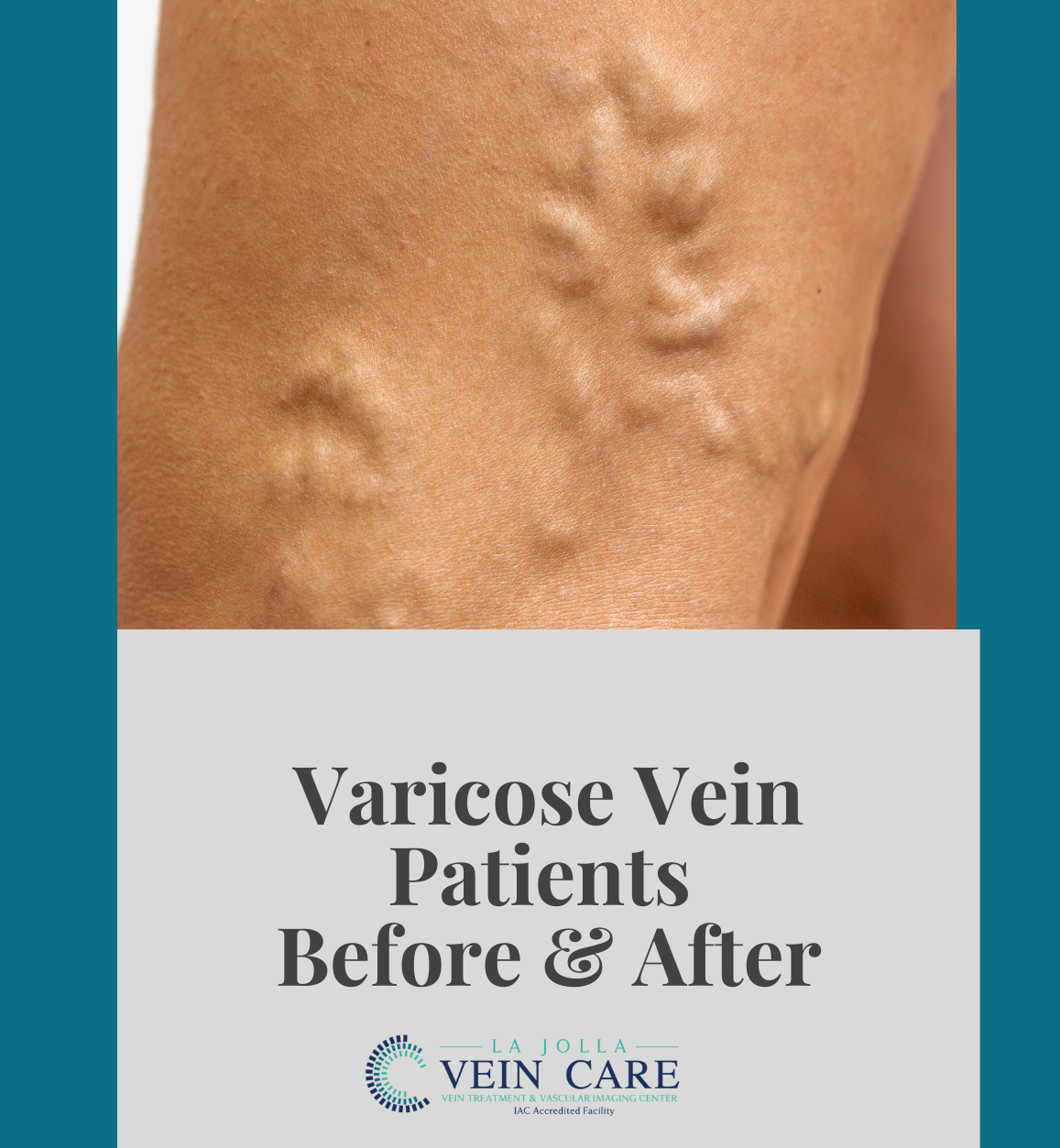 varicoseveinbeforeandafter varicoseveinbeforeandafter