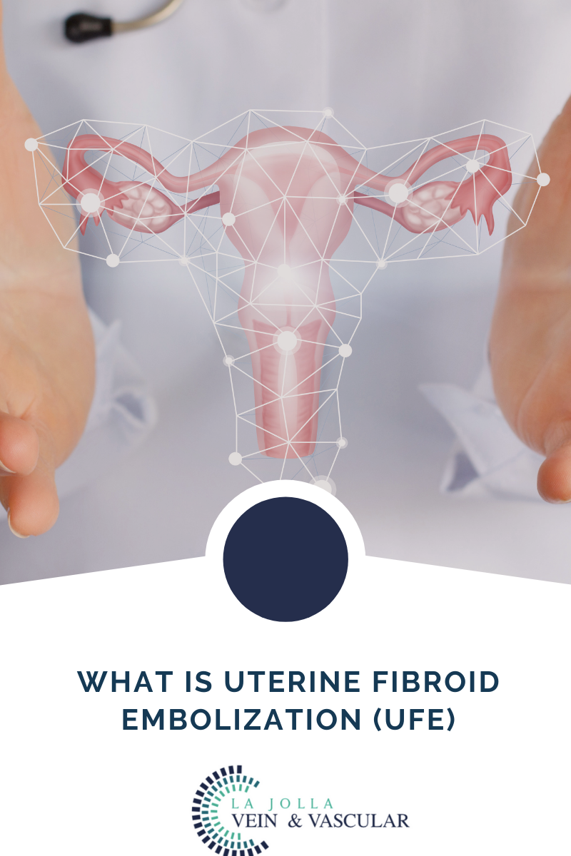 8 Uterine Fibroid Embolization