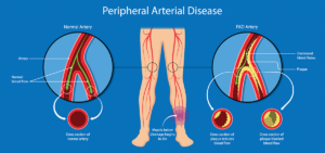 peripheral arterial disease
