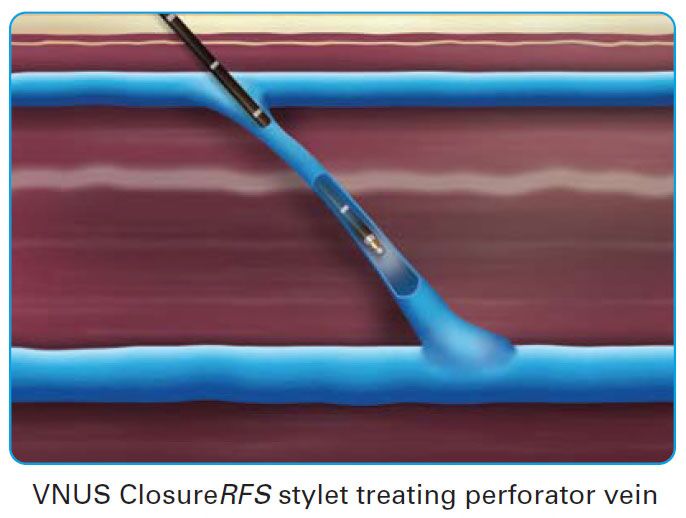 VNUSClosure-Perforator-Veins VNUSClosure Perforator Veins