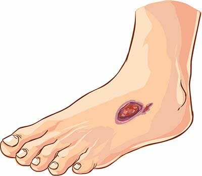 Non-Healing Wounds or Ulcers - Symptoms, Causes & Treatment