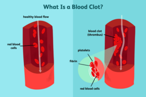 blood-clots