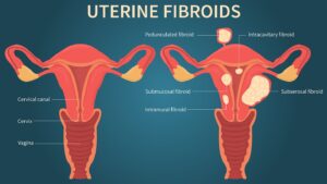 uterine fibroids