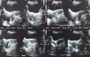 What causes uterine fibroids? 1 uterine fibroids