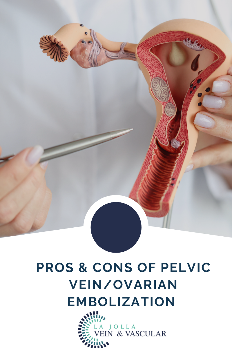 7 pelvic vein embolization
