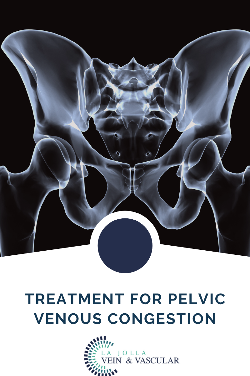 8 Pelvicvenouscongestion