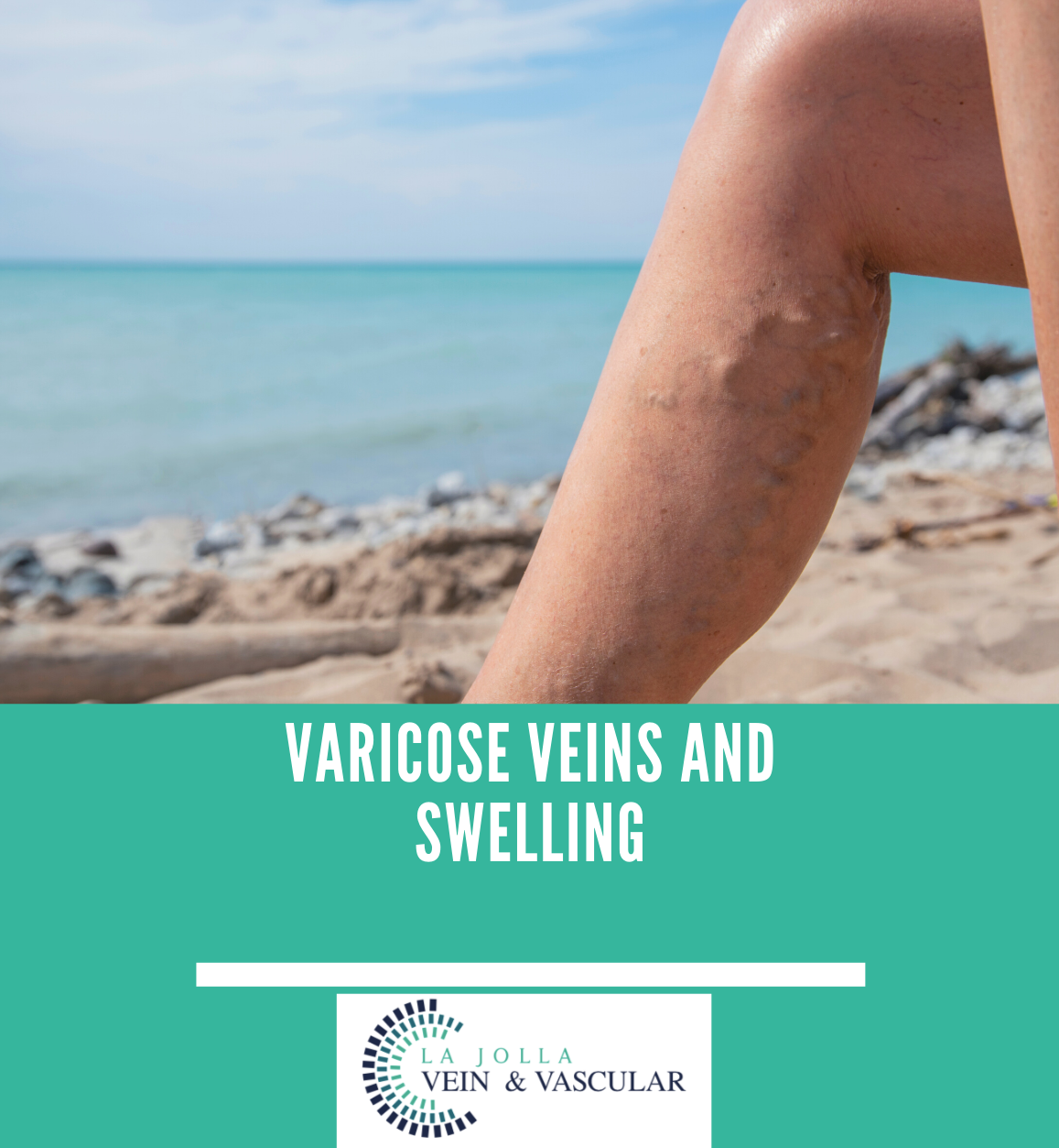 Bunke Blog Graphics4-16 varicose veins