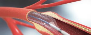 angioplasty
