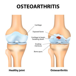 osteoarthritis