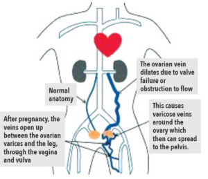 labialvaricosities