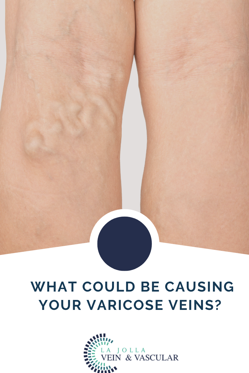 varicose veins