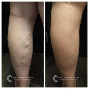 varicose veins