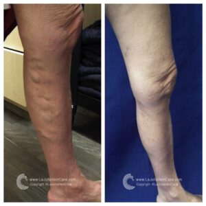 varicose veins