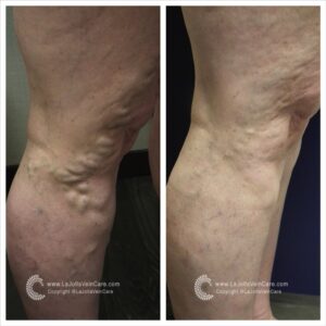 varicose veins