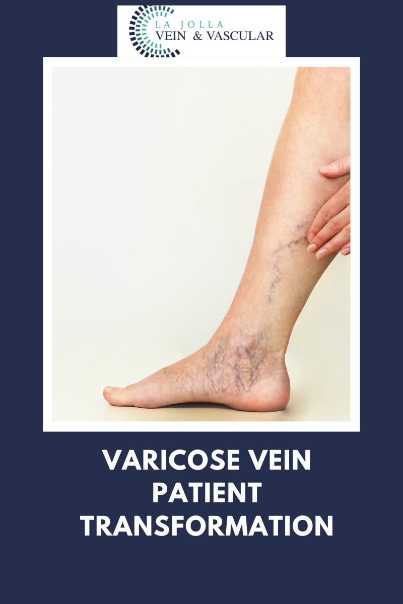 3 varicose veins