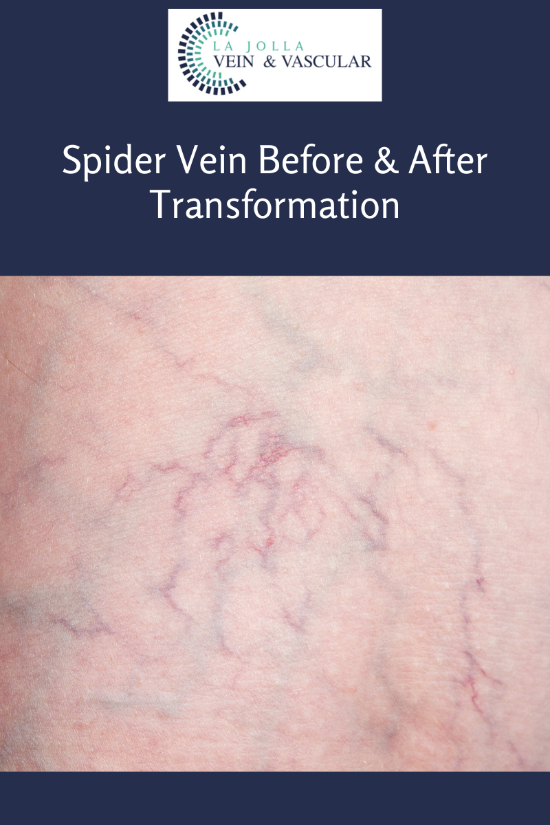 spidervein