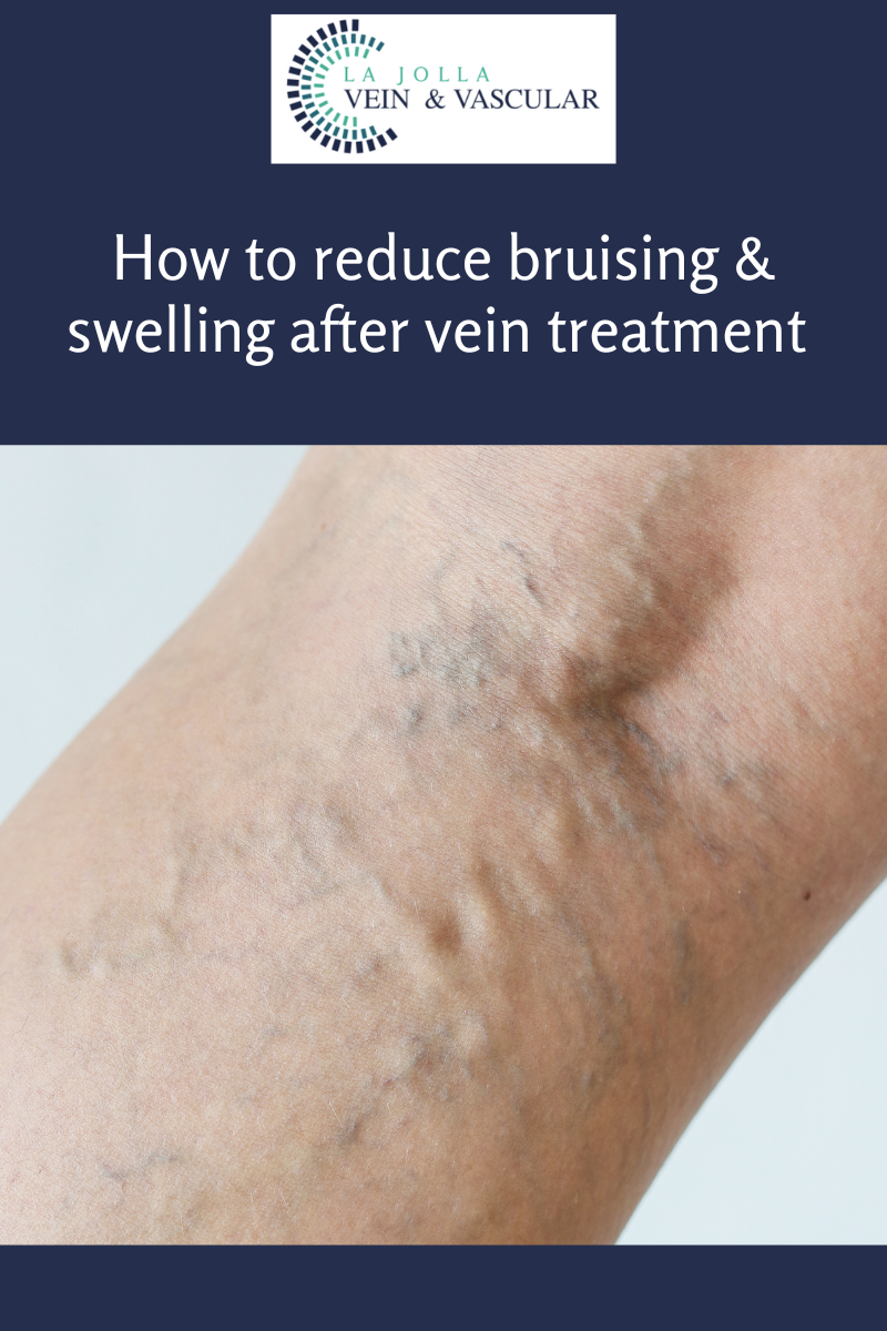 bruising