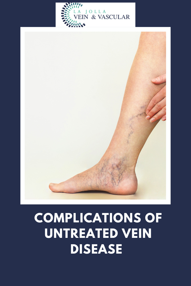 6 vein disease