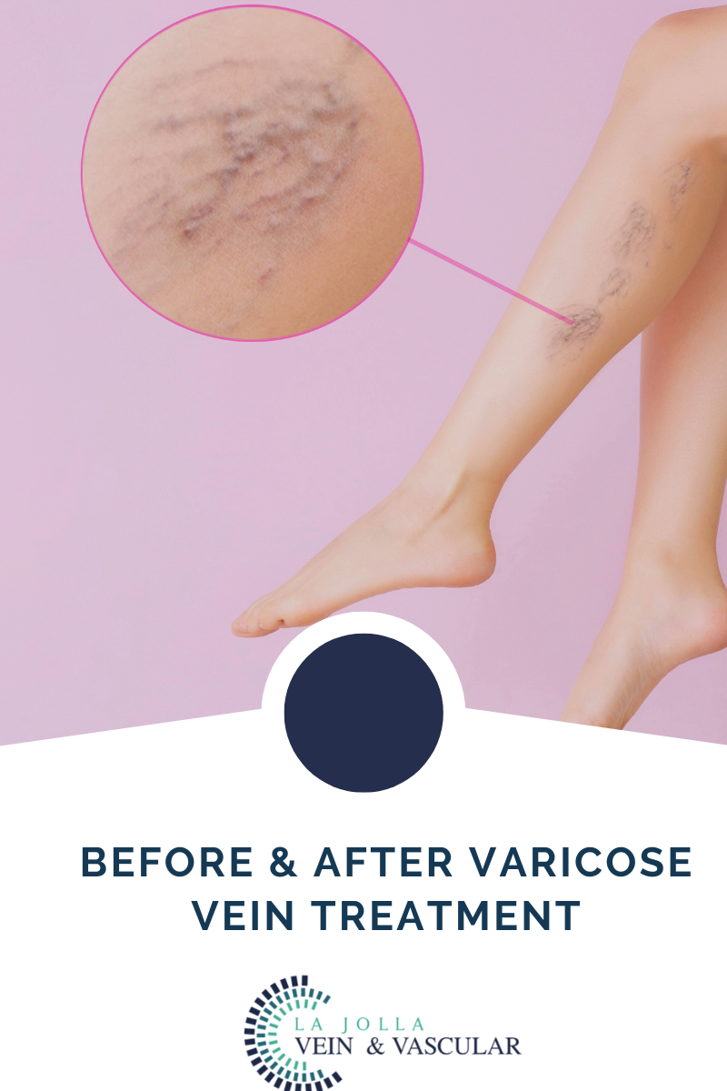 7 varicose veins