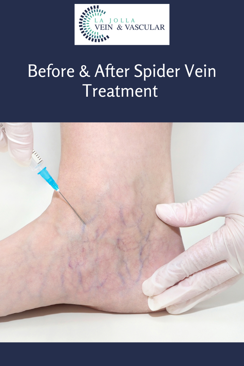 spider veins