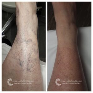 sclerotherapy